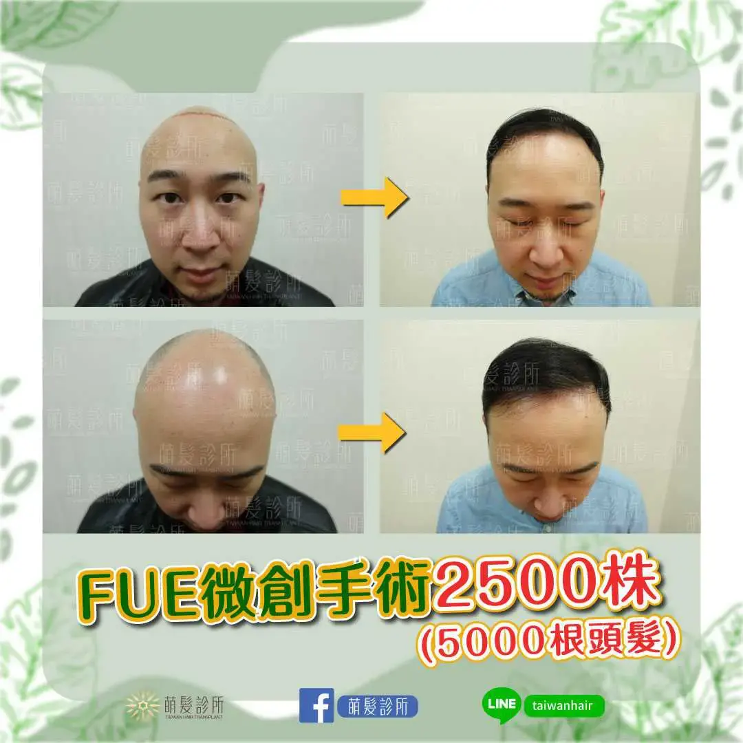 A graft is a follicular unit (may hold 1–4 hairs); grafts are roughly area × density, but still adjusted for donor supply and native hair