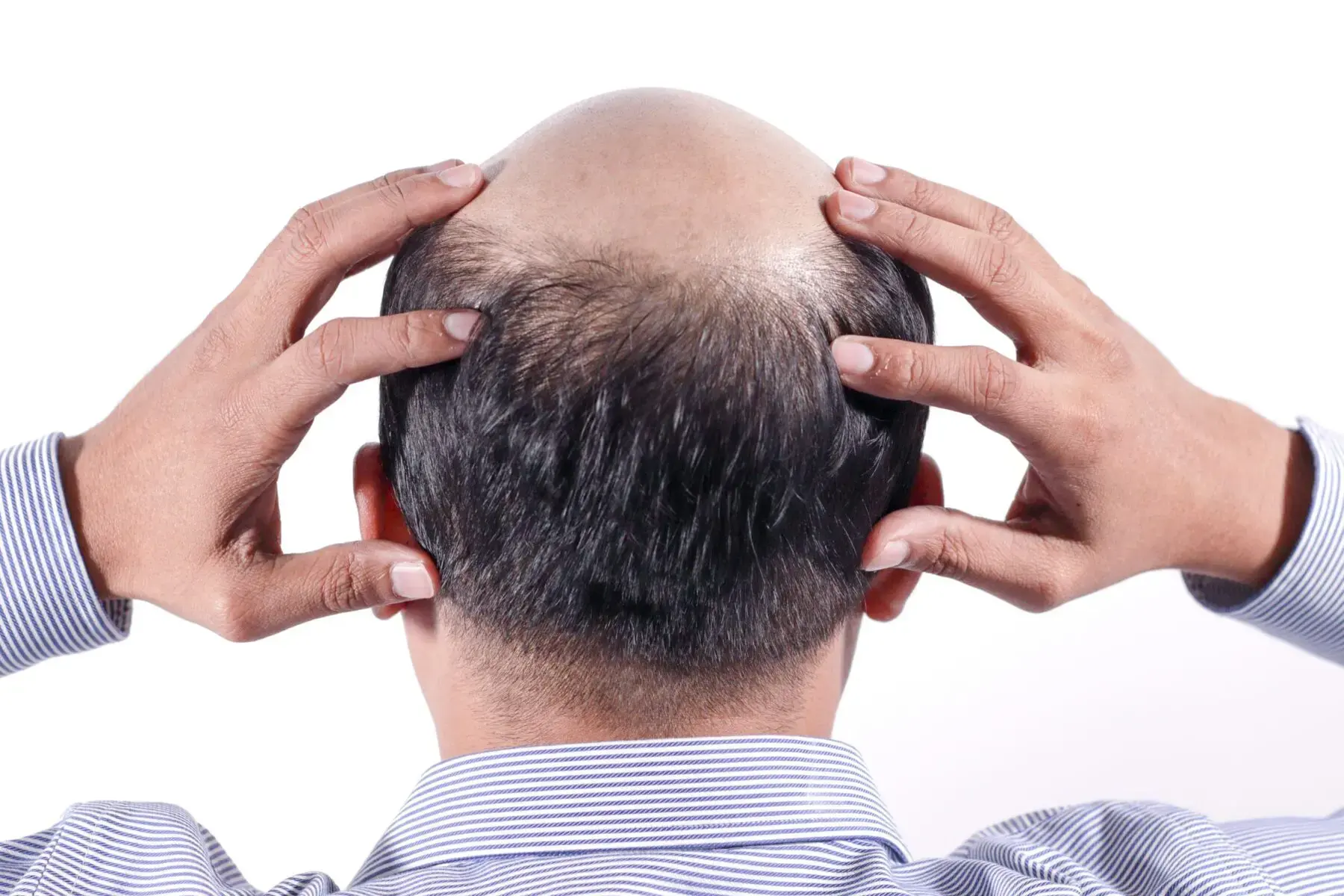 Donor condition matters more than age — whether the back of the scalp has enough good-quality follicles is the core question