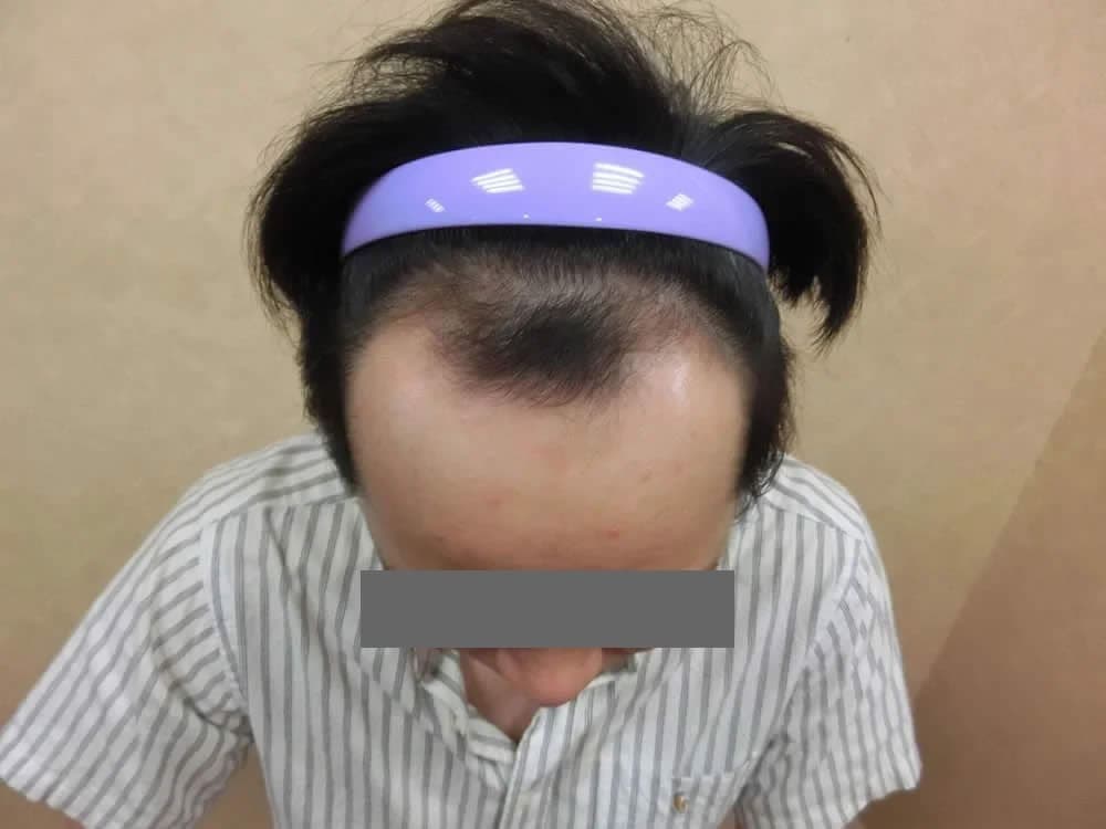 FUE 1,800 術前