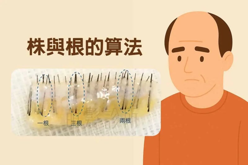 なぜ植毛は「株（かぶ）」で計るんだ？