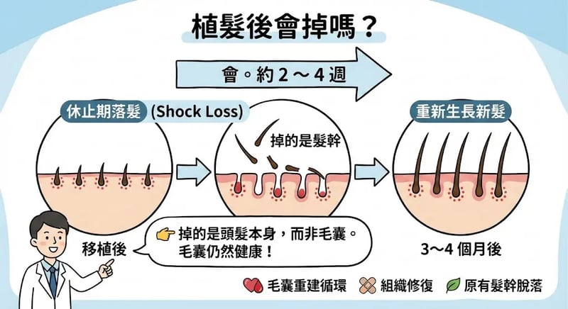 植毛後に髪は抜ける？ショックロス・元の毛・生えるまでの期間
