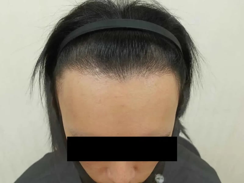 植发案例｜高额头 — 正面发际线俯视：植发后