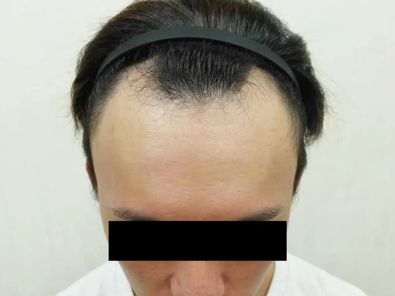 植发案例｜高额头 — 正面发际线俯视：植发前