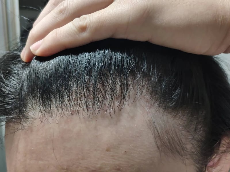 Hair transplant case｜High forehead — Front hairline：~7 months post-op