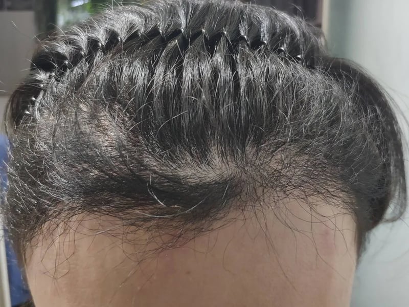 Hair transplant case｜High forehead — Front hairline：~5 months post-op