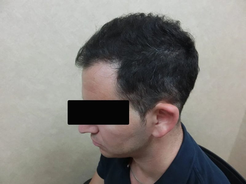 FUE 2,900 株｜前额至头顶 — 左侧额角：植发后