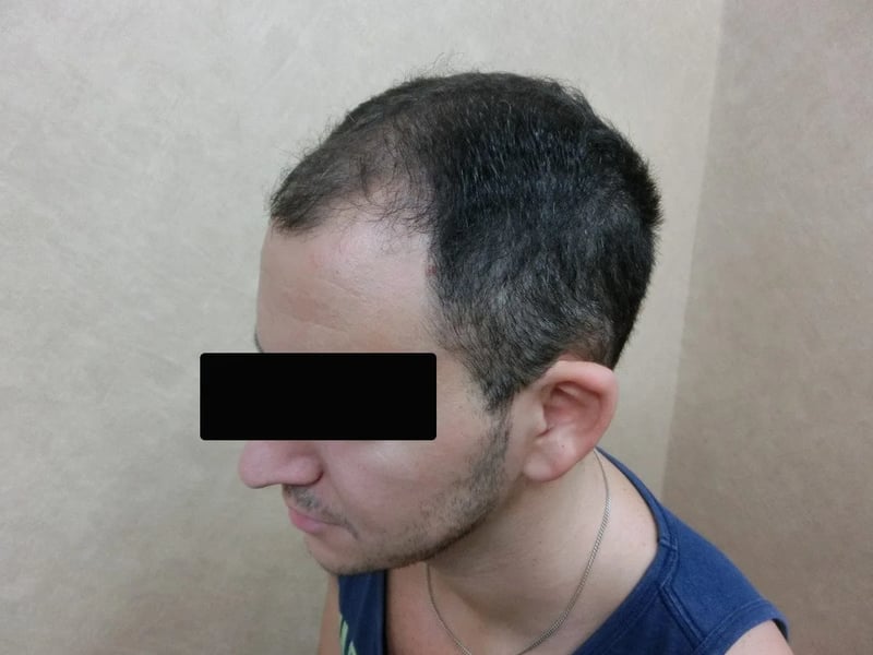 FUE 2,900 株｜前额至头顶 — 左侧额角：植发前