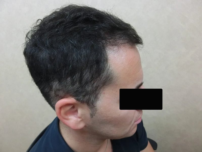 FUE 2,900 株｜前額至頭頂 — 右側額角：植髮後