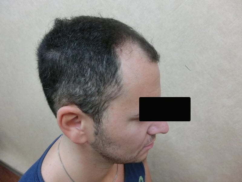 FUE 2,900 株｜前額至頭頂 — 右側額角：植髮前