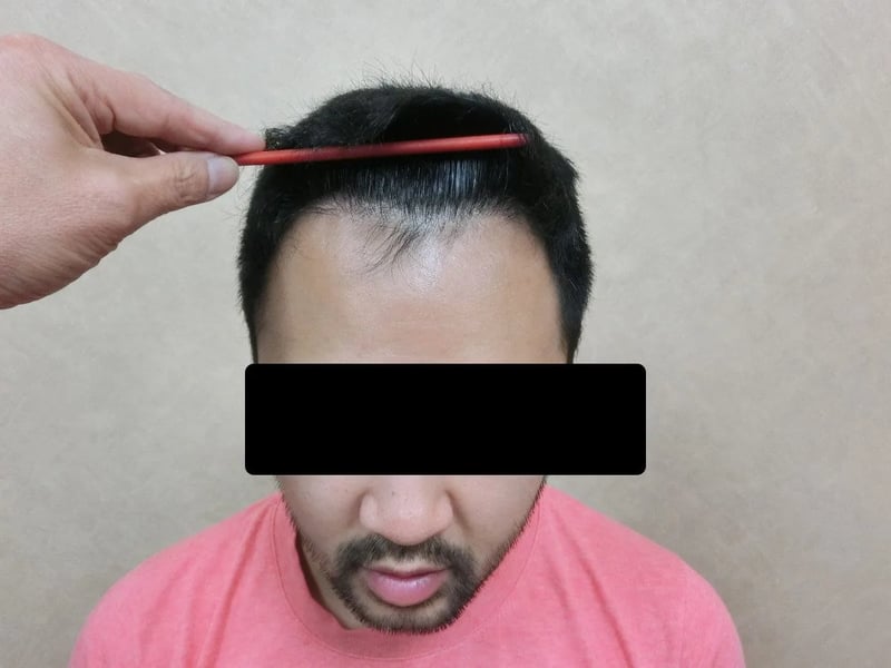 FUE 1,523 株｜M型发际线 — 正面发际线俯视：植发后