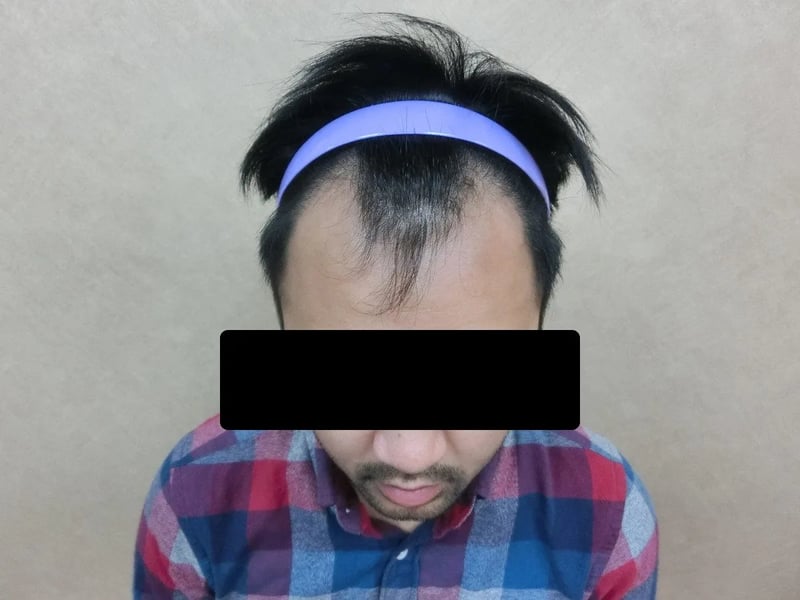 FUE 1,523 株｜M型发际线 — 正面发际线俯视：植发前