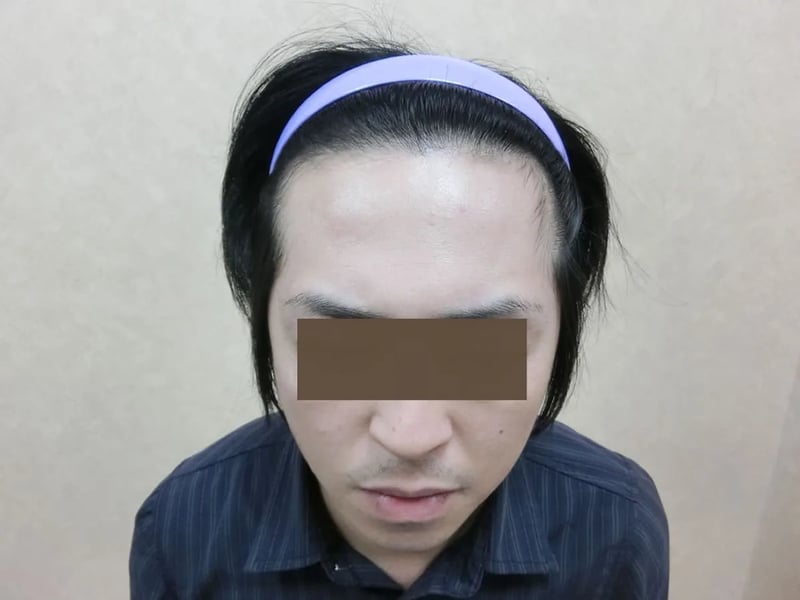 FUE 1,121 株｜前额发际线 — 正面发际线：植发后