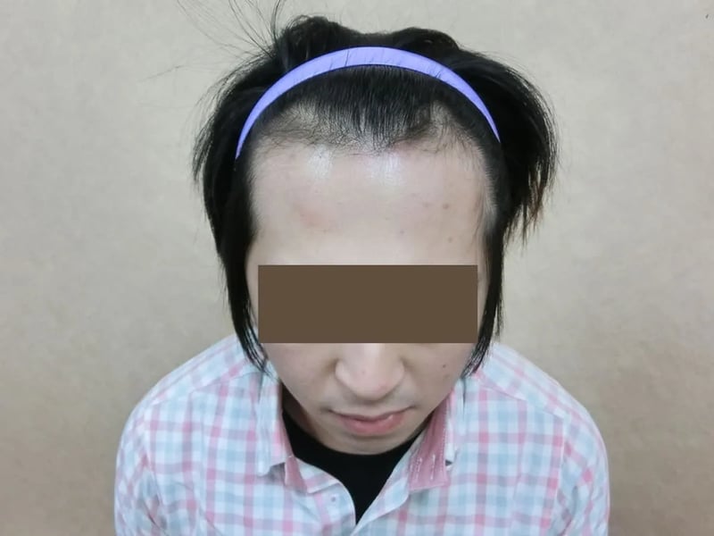 FUE 1,121 株｜前额发际线 — 正面发际线：植发前