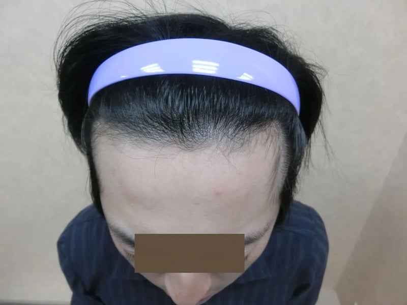 FUE 1,121 株｜前額髮線 — 前額俯視：植髮後