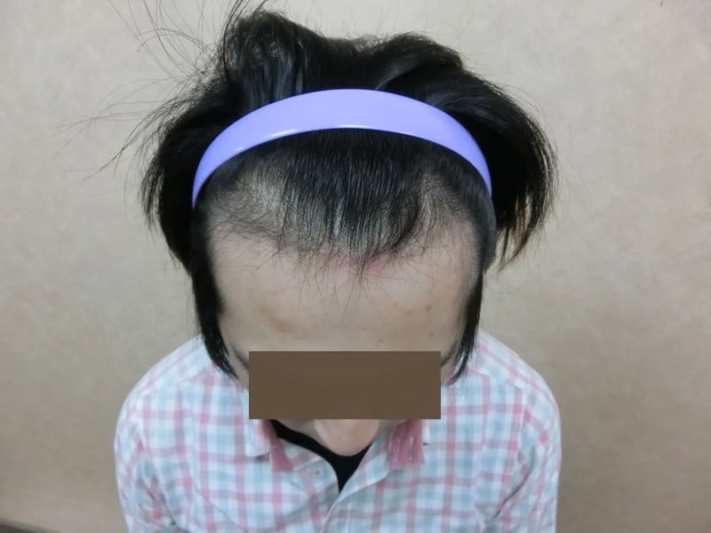 FUE 1,121 株｜前額髮線 — 前額俯視：植髮前
