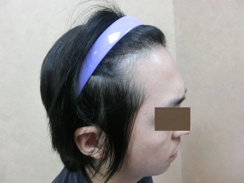 FUE 1,121 株｜前額髮線 — 前額前上方：植髮後