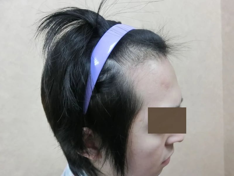 FUE 1,121 株｜前額髮線 — 前額前上方：植髮前