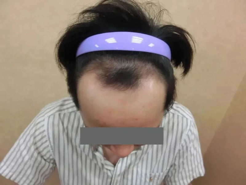 FUE 1,800 株｜前额发际线 — 正面发际线：植发前