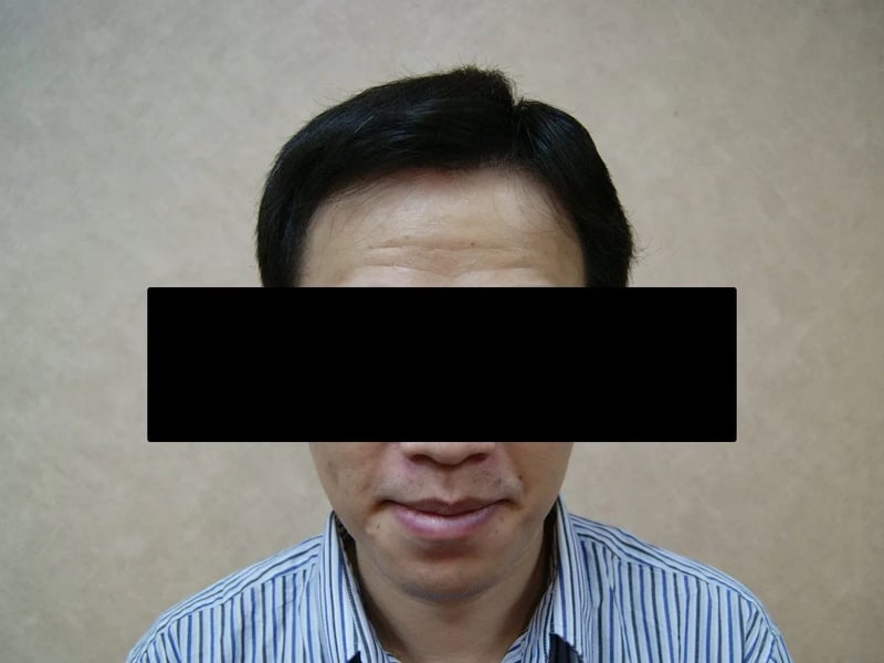 FUE 1,632 株｜前额发际线 — 正面发际线：植发后