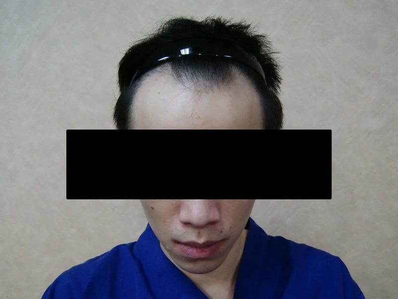 FUE 1,632 株｜前额发际线 — 正面发际线：植发前