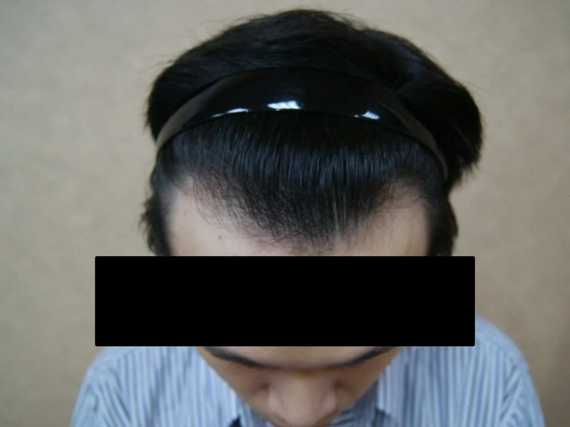 FUE 1,632 株｜前额发际线 — 前额俯视：植发后