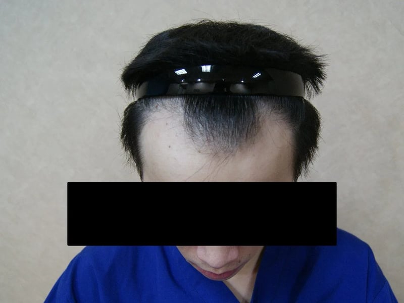 FUE 1,632 株｜前额发际线 — 前额俯视：植发前