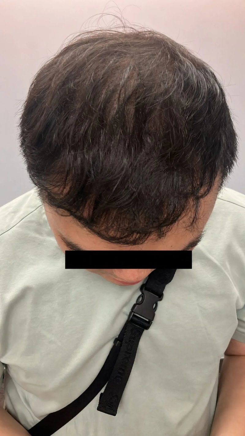 FUE 3,000 株｜前额至头顶 — 前额至头顶俯视：植发后