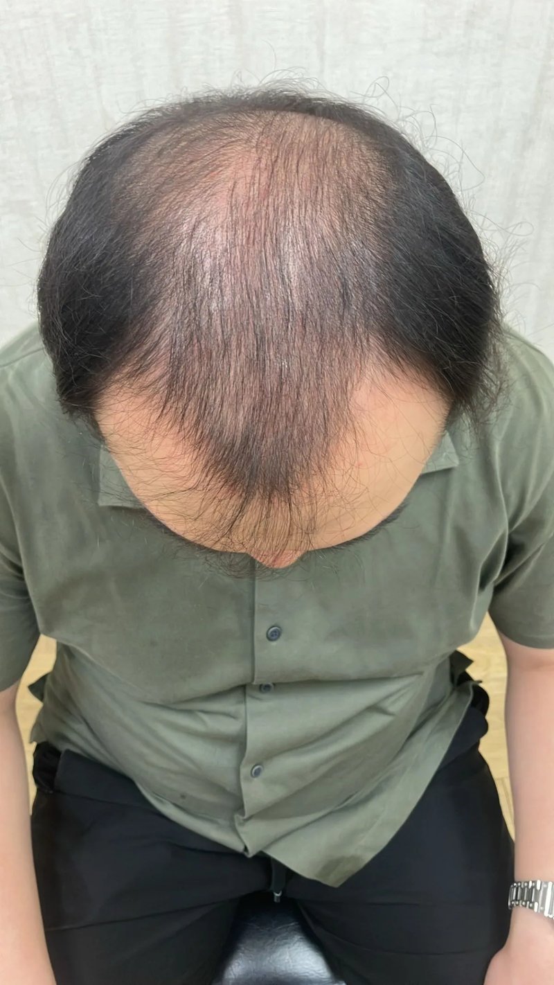 FUE 3,000 株｜前额至头顶 — 前额至头顶俯视：植发前