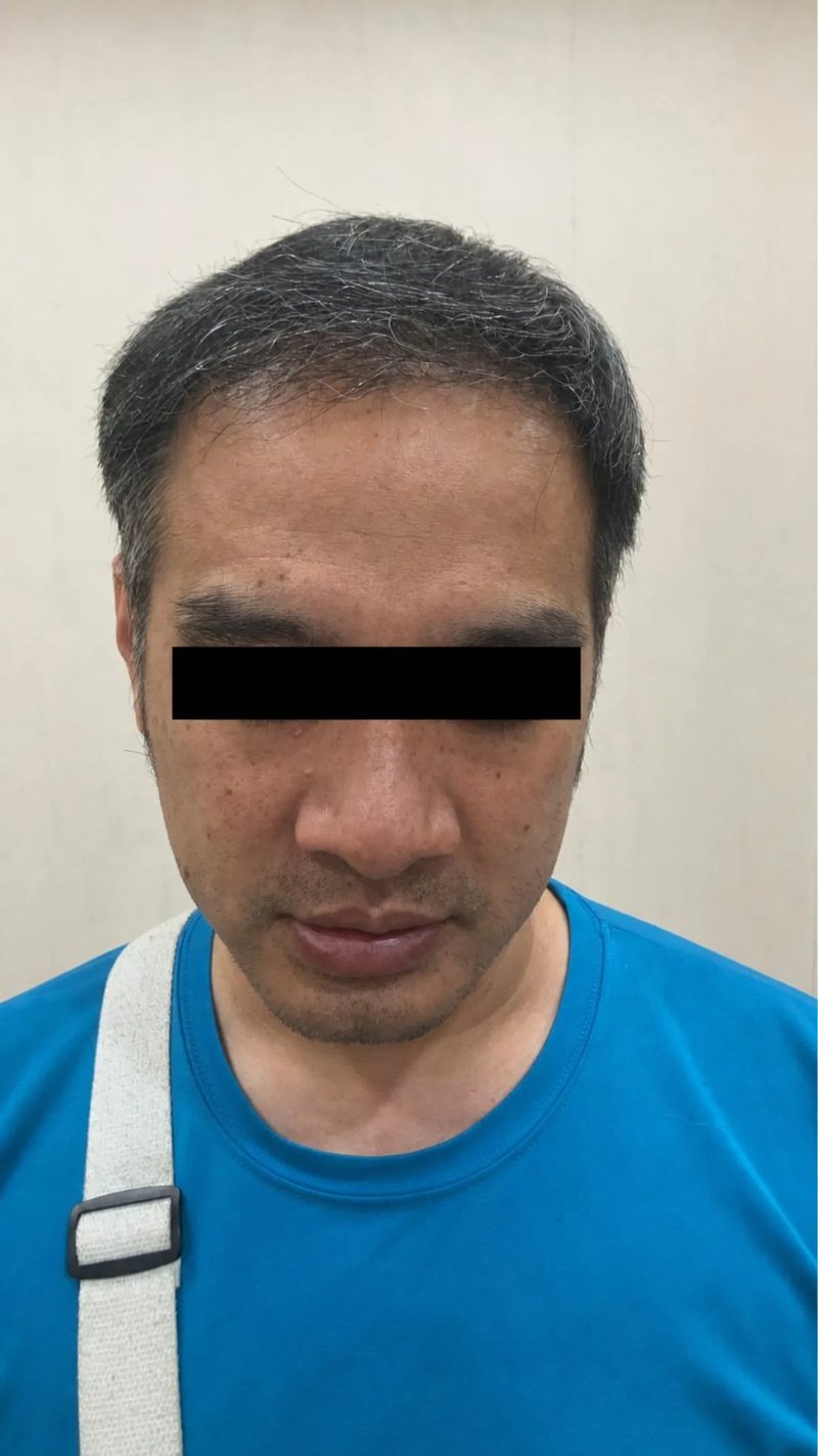 植发案例｜发际线与头顶发旋 — 正面发际线：植发后