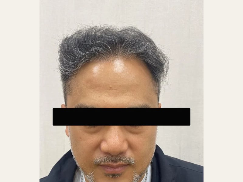 植发案例｜发际线与头顶发旋 — 正面发际线：植发后