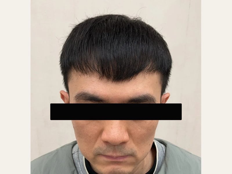 植发案例｜前额至头顶中央 — 正面发际线：植发后