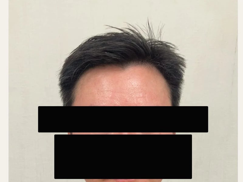 FUE 1,200 株｜前额发际线 — 正面发际线：植发后