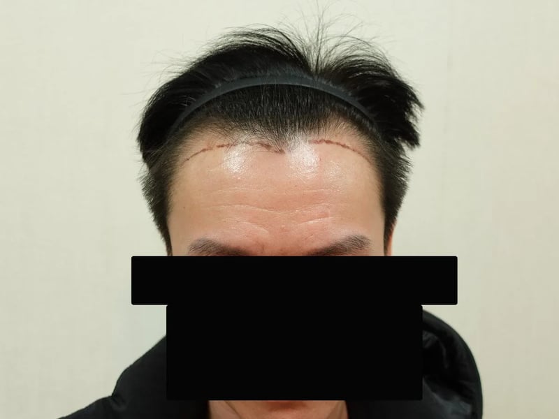 FUE 1,200 株｜前额发际线 — 正面发际线：植发前