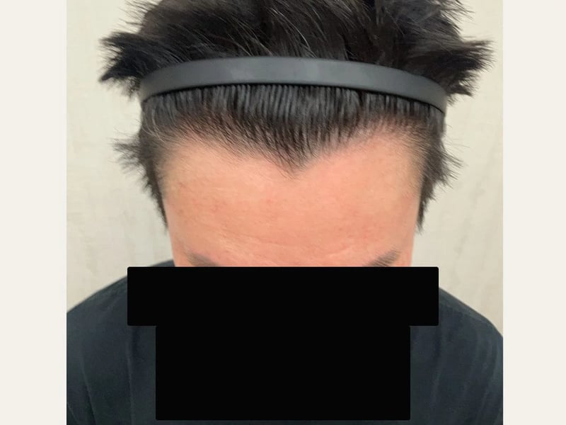 FUE 1,200 株｜前額髮線 — 前額俯視：植髮後