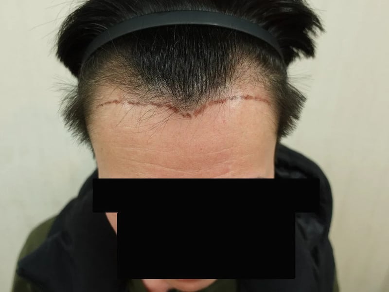 FUE 1,200 株｜前額髮線 — 前額俯視：植髮前
