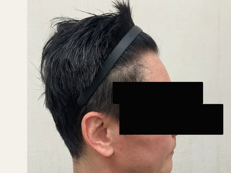 FUE 1,200 株｜前額髮線 — 右側額角：植髮後