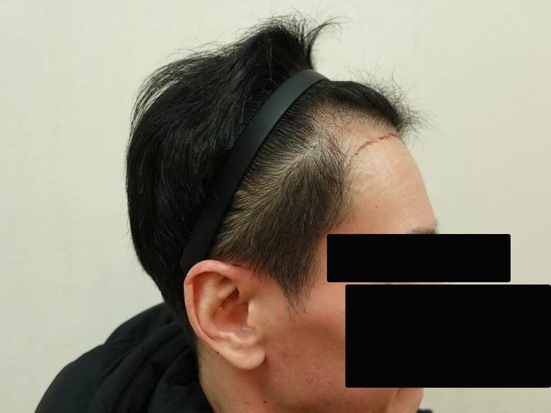 FUE 1,200 株｜前額髮線 — 右側額角：植髮前