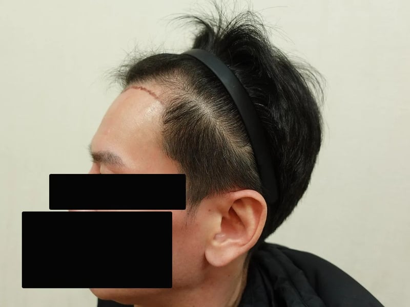 FUE 1,200 株｜前額髮線 — 左側額角：植髮前