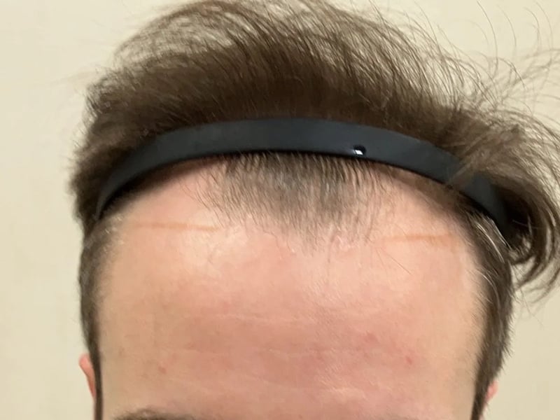 FUE 2,000 株｜前额至头顶中央 — 正面发际线：植发前