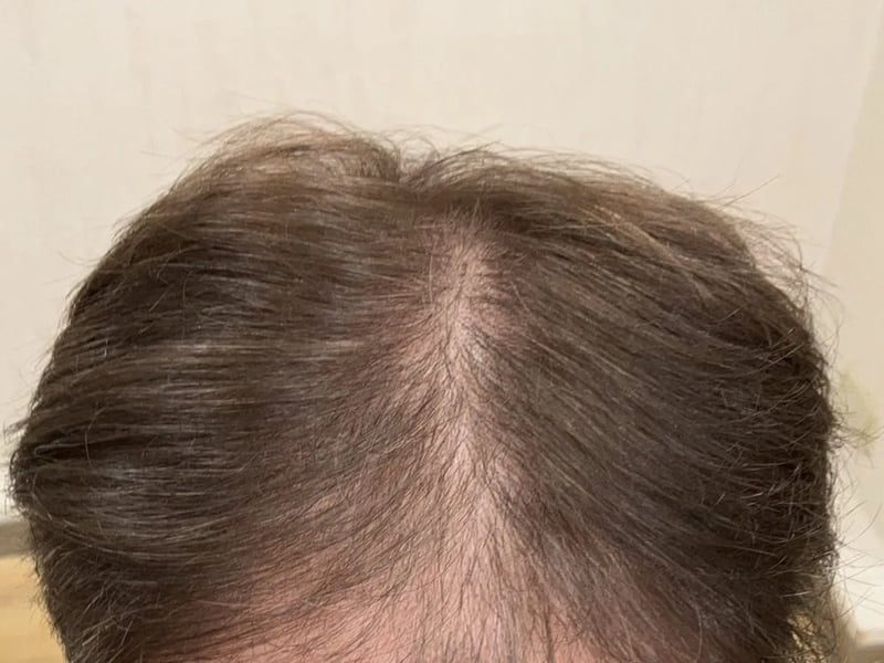 FUE 2,000株｜前頭部〜頭頂中央 — 前頭部〜頭頂部（上から）：術前