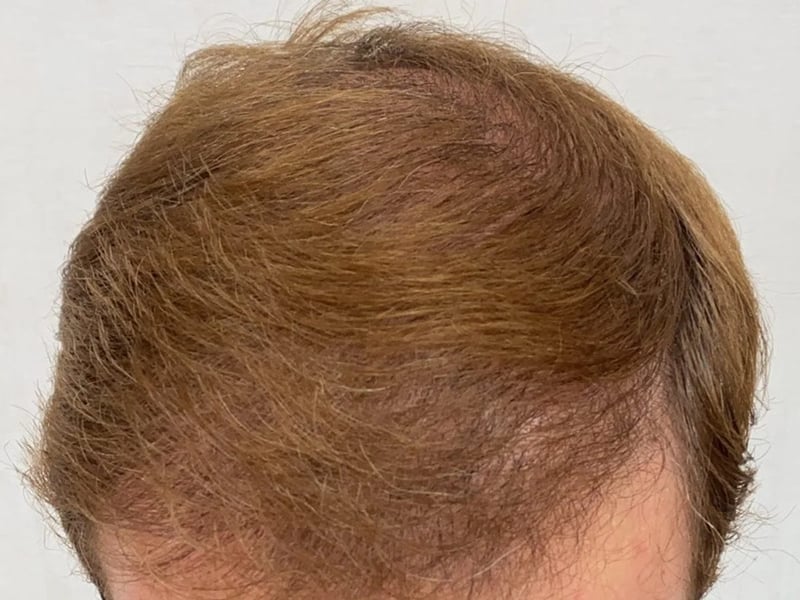 COMBO 4,500 株｜前額至頭頂 — 前額俯視：植髮後
