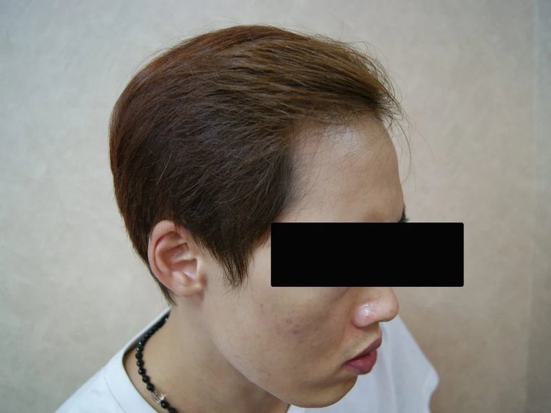FUE 3,013 株｜双侧额角 — 右侧额角：植发后