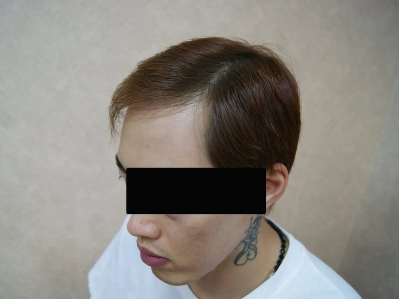 FUE 3,013 株｜雙側額角 — 左側額角：植髮後
