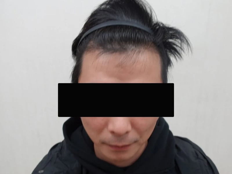 植发案例｜前额发际线 — 正面发际线：植发后