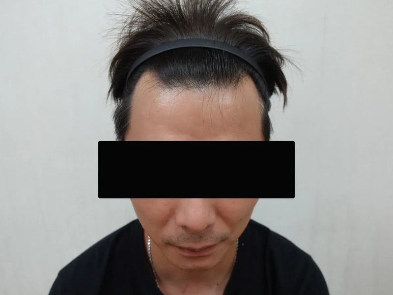 植发案例｜前额发际线 — 正面发际线：植发前