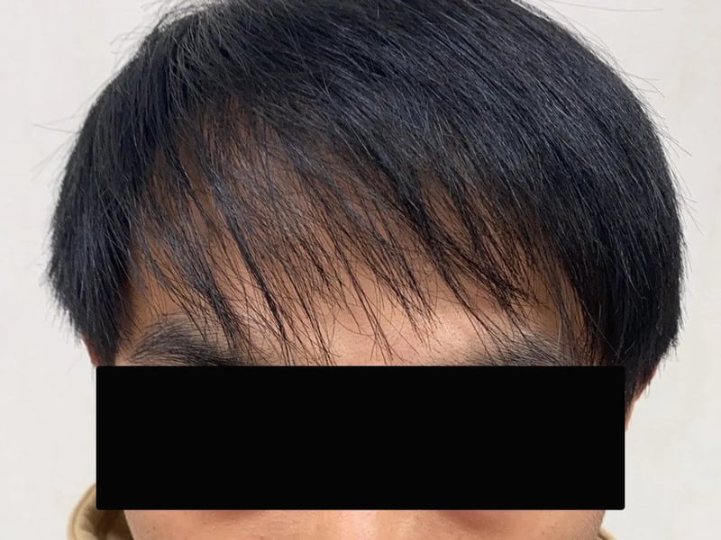 植发案例｜前额至头顶 — 正面发际线：植发后