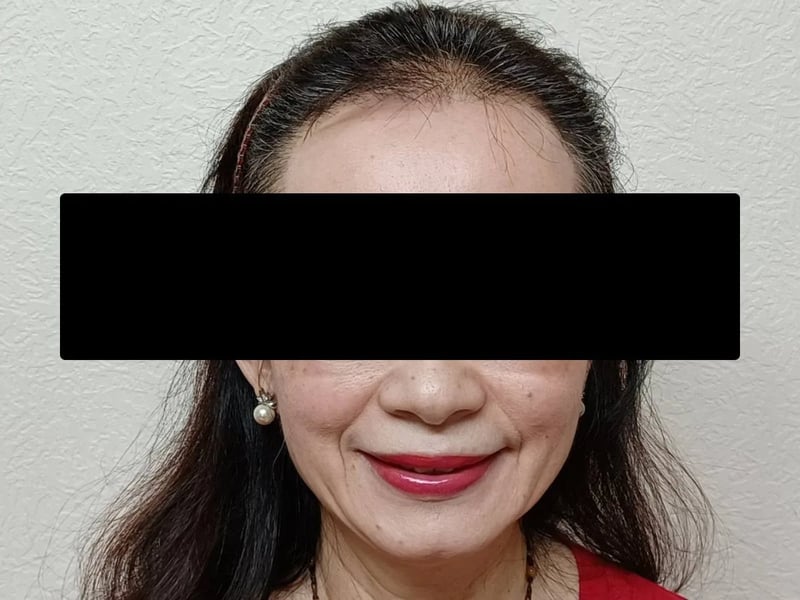 植发案例｜前额发际线 — 正面发际线：术后约 11 个月
