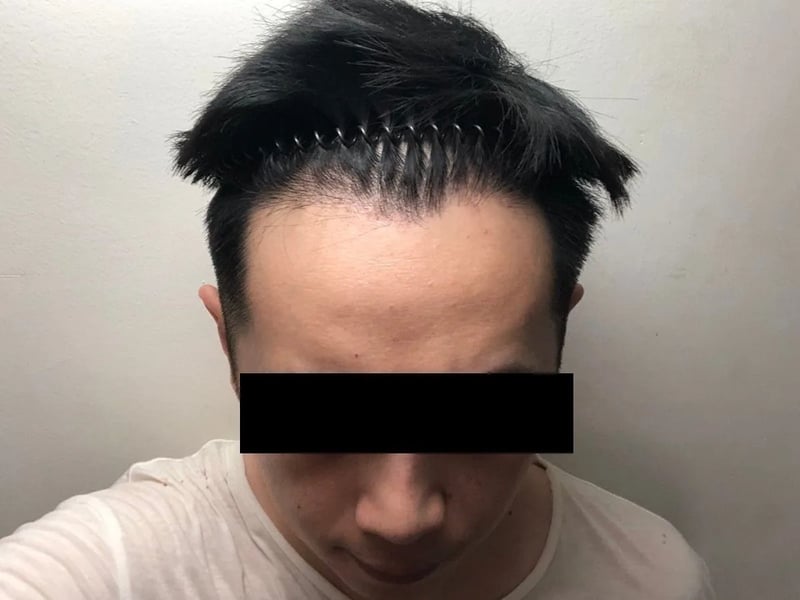 植发案例｜M型发际线 — 正面发际线：术后约 7 个月