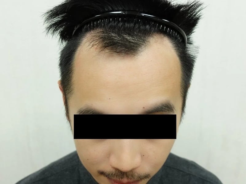植发案例｜M型发际线 — 正面发际线：植发前