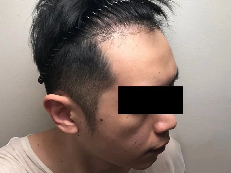 植发案例｜M型发际线 — 右侧额角：术后约 7 个月